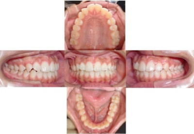 健康な歯の人の口腔内写真
